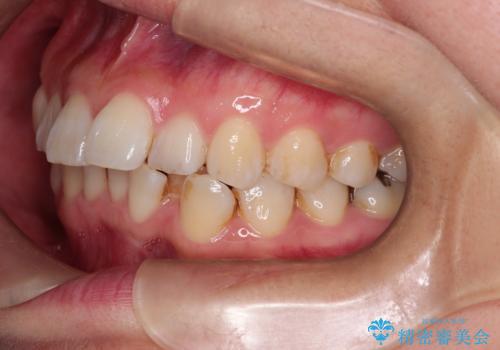 マウスピースで歯並びと正中を改善の治療前