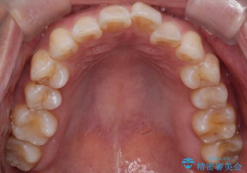 マウスピースで歯並びと正中を改善の治療前