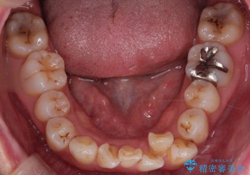 マウスピースで歯並びと正中を改善の治療前