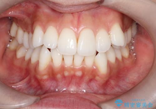 口元と八重歯を整えたワイヤー矯正