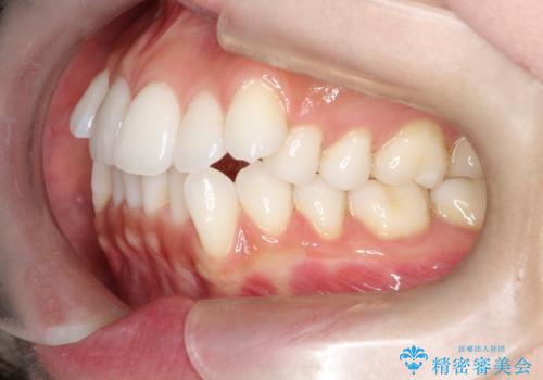 口元と八重歯を整えたワイヤー矯正の治療前