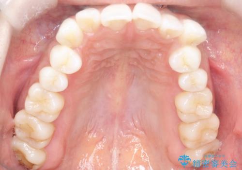 口元と八重歯を整えたワイヤー矯正の治療前