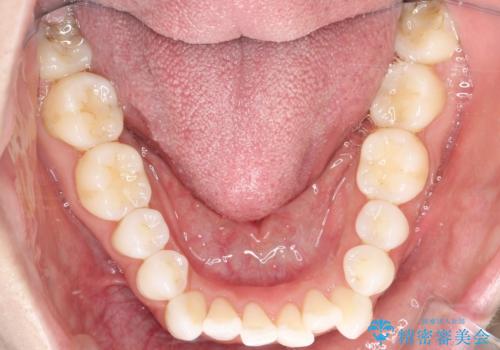 口元と八重歯を整えたワイヤー矯正の治療前