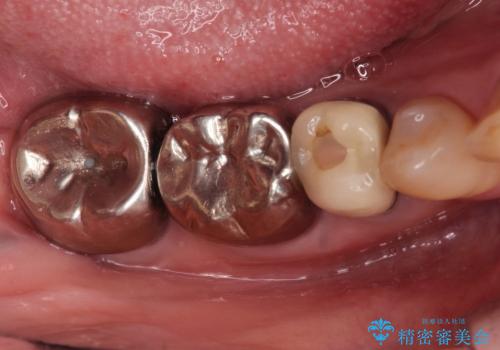 目立つ銀歯を白く自然な歯に改善の症例 治療前