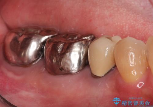 目立つ銀歯を白く自然な歯に改善の治療前