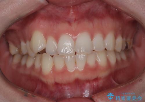 抜歯せずに八重歯を解消!アンカースクリューで実現した奥歯の移動の治療前