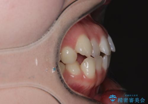 抜歯せずに八重歯を解消!アンカースクリューで実現した奥歯の移動の治療前