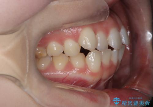 抜歯せずに八重歯を解消!アンカースクリューで実現した奥歯の移動の治療前