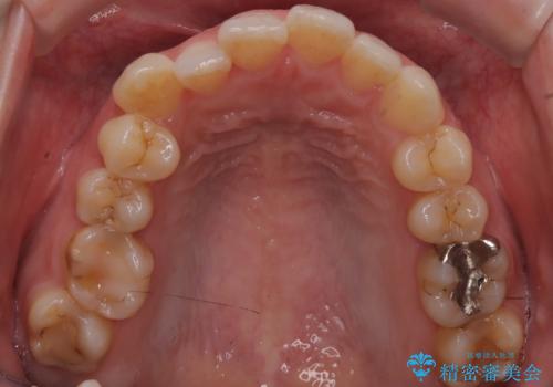 抜歯せずに八重歯を解消!アンカースクリューで実現した奥歯の移動の治療前
