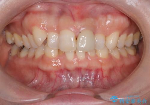 八重歯と口元のバランスを整えた矯正治療の治療前