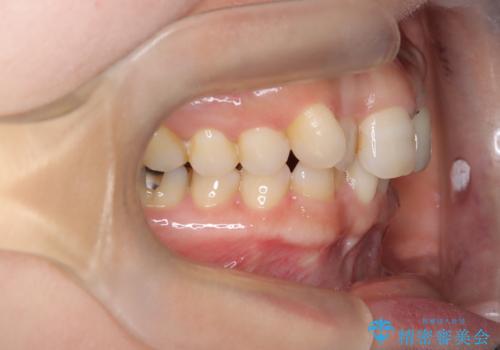 八重歯と口元のバランスを整えた矯正治療の治療前