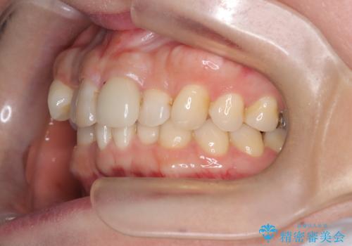 八重歯と口元のバランスを整えた矯正治療の治療前