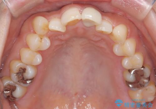 八重歯と口元のバランスを整えた矯正治療の治療前