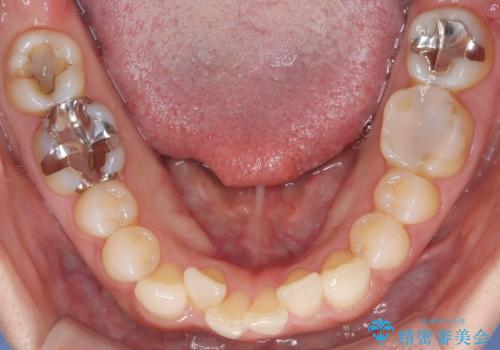 八重歯と口元のバランスを整えた矯正治療の治療前