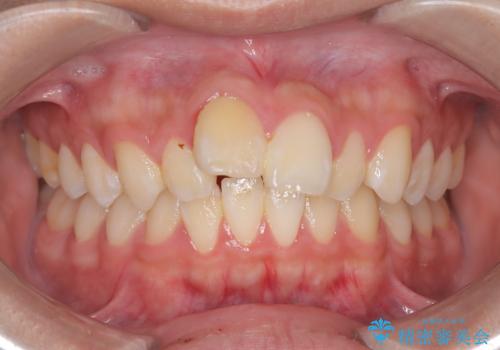 【ワイヤー矯正】前歯が出ているのが気になるの治療前