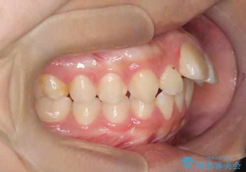 【ワイヤー矯正】前歯が出ているのが気になるの治療前