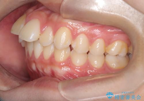 【ワイヤー矯正】前歯が出ているのが気になるの治療前