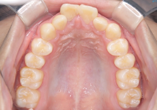 【ワイヤー矯正】前歯が出ているのが気になるの治療前