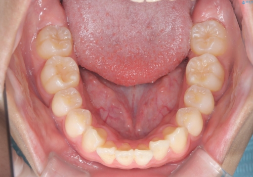 【ワイヤー矯正】前歯が出ているのが気になるの治療前