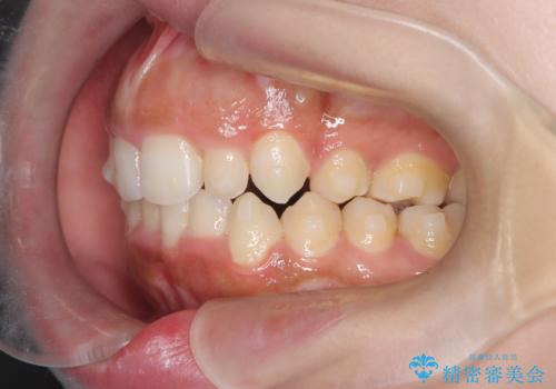前歯の出っ張りとガタつきを改善の治療中