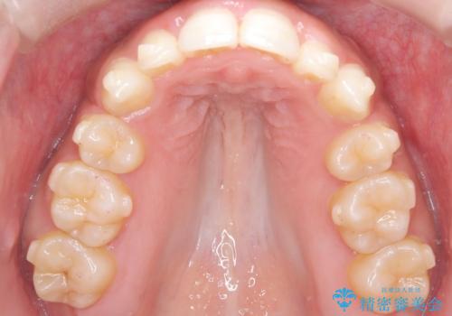 前歯の出っ張りとガタつきを改善の治療中