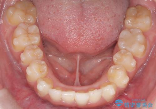 前歯の出っ張りとガタつきを改善の治療中