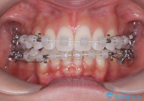 口元と八重歯を整えたワイヤー矯正の治療中