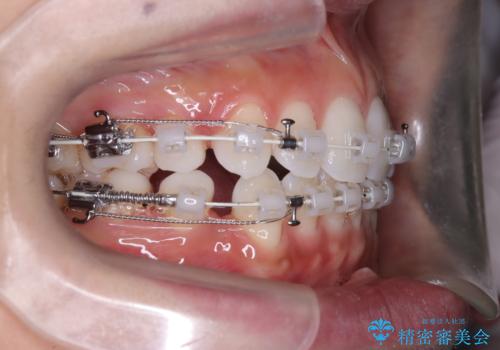口元と八重歯を整えたワイヤー矯正の治療中
