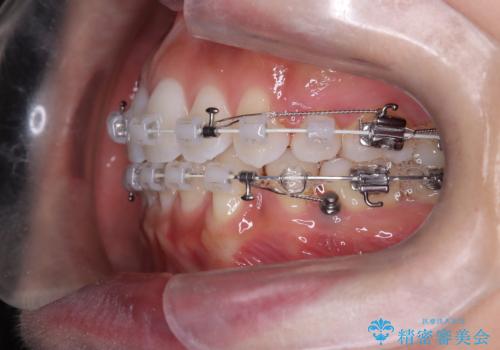 口元と八重歯を整えたワイヤー矯正の治療中