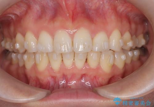 マウスピースで歯並びと正中を改善の治療中