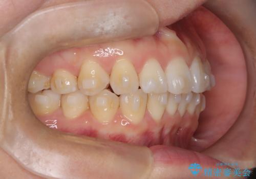 マウスピースで歯並びと正中を改善の治療中