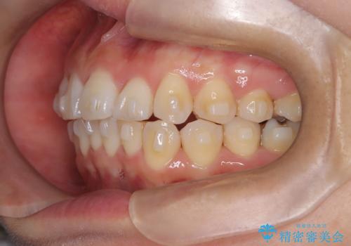 マウスピースで歯並びと正中を改善の治療中