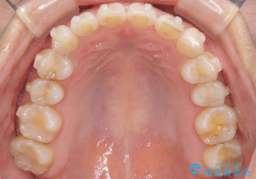 マウスピースで歯並びと正中を改善の治療中