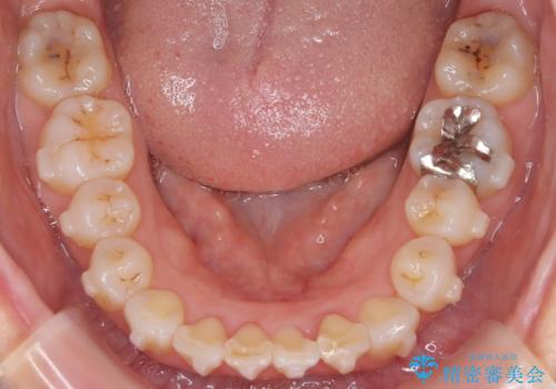 マウスピースで歯並びと正中を改善の治療中