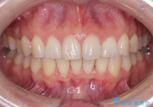 マウスピースで歯並びと正中を改善の治療後