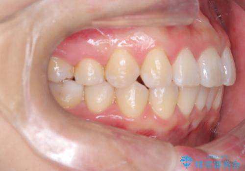 マウスピースで歯並びと正中を改善の治療後