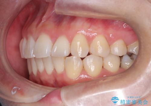 マウスピースで歯並びと正中を改善の治療後