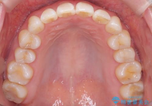 マウスピースで歯並びと正中を改善の治療後