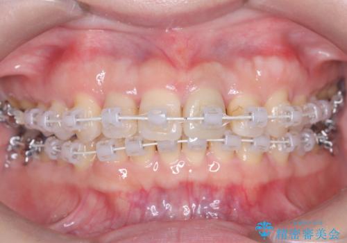 八重歯と口元のバランスを整えた矯正治療の治療中