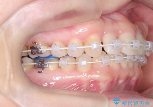 八重歯と口元のバランスを整えた矯正治療の治療中