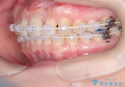 八重歯と口元のバランスを整えた矯正治療の治療中