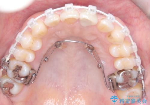 八重歯と口元のバランスを整えた矯正治療の治療中