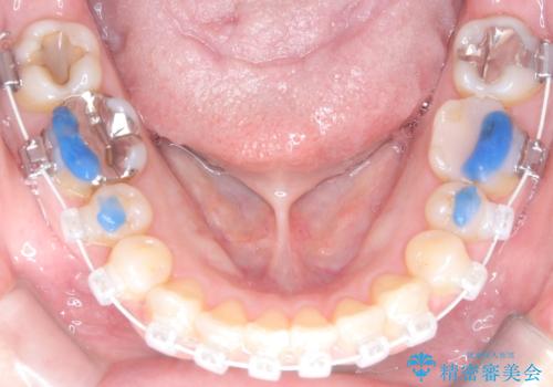 八重歯と口元のバランスを整えた矯正治療の治療中