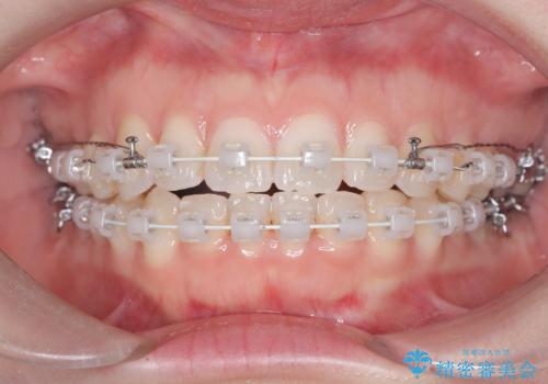 抜歯せずに八重歯を解消!アンカースクリューで実現した奥歯の移動の治療中