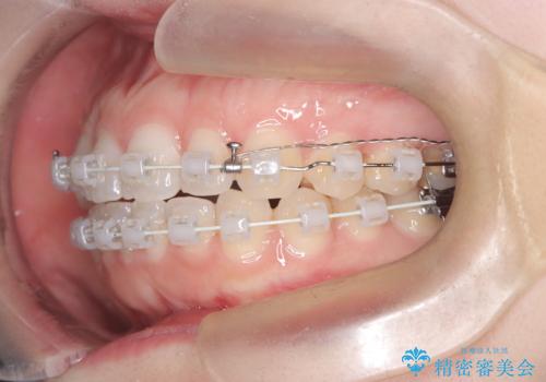 抜歯せずに八重歯を解消!アンカースクリューで実現した奥歯の移動の治療中
