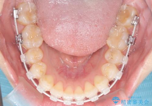 抜歯せずに八重歯を解消!アンカースクリューで実現した奥歯の移動の治療中