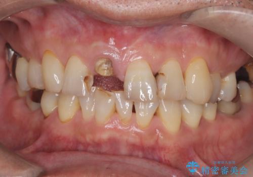 折れた前歯を即時インプラントで回復の症例 治療前