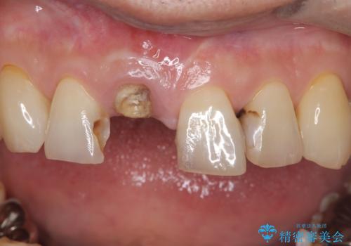折れた前歯を即時インプラントで回復の治療前