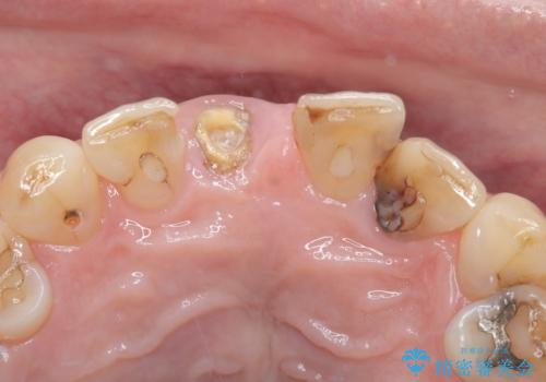 折れた前歯を即時インプラントで回復の治療前