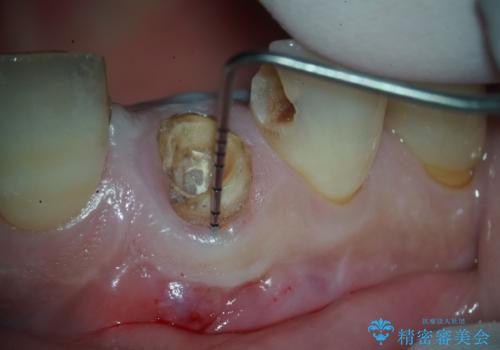 折れた前歯を即時インプラントで回復の治療中